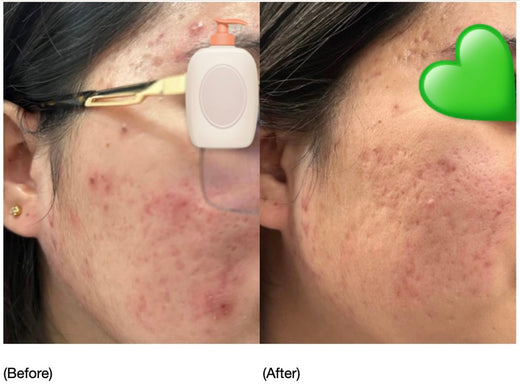 Treatment Set for Acne Skin, Recommended by Jin and Jenny, MORE from Korea